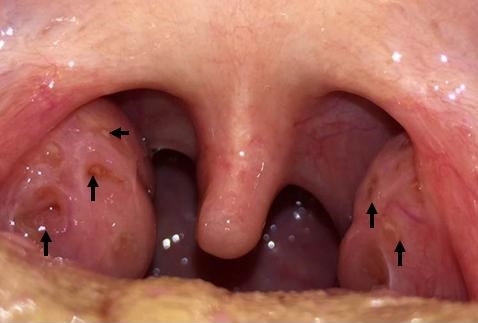 Enlarged Tonsils Adult 100